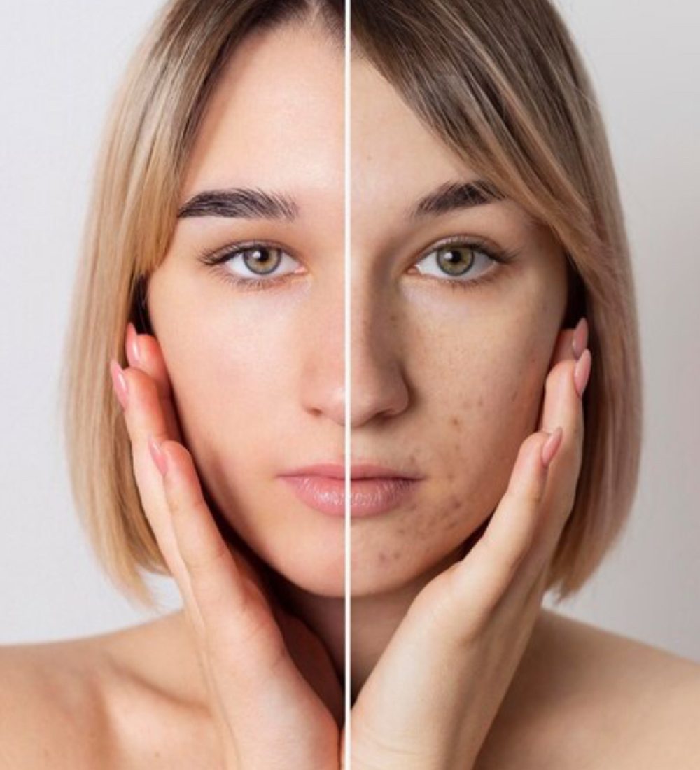 before and after image of acne reduction