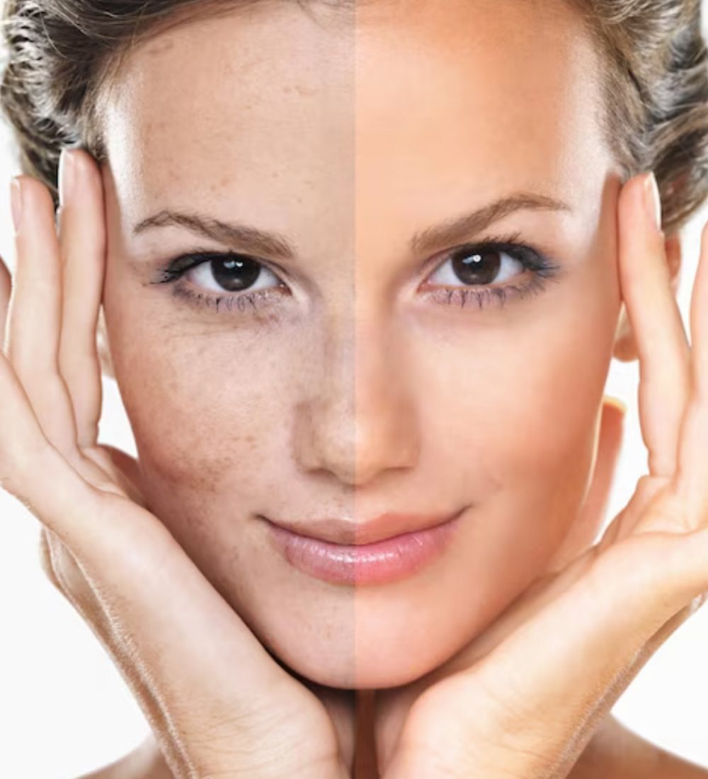 Before and after image of acne reduction
