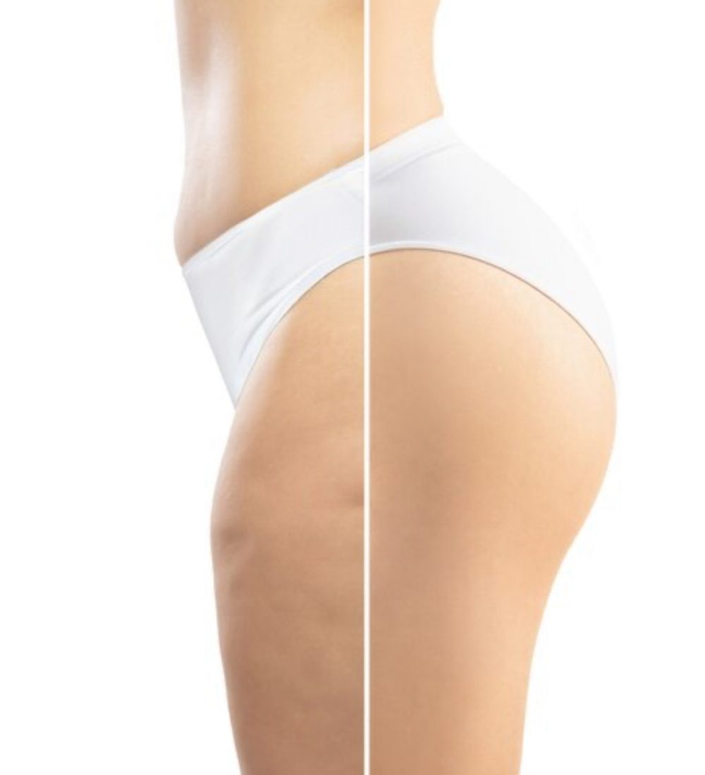 a closeup of buttock - skin tightening