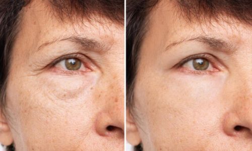 before and after pic of rejuvination